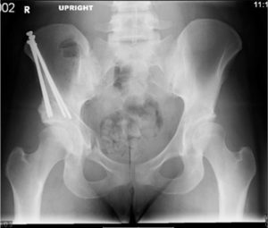 X-ray of hip with screws